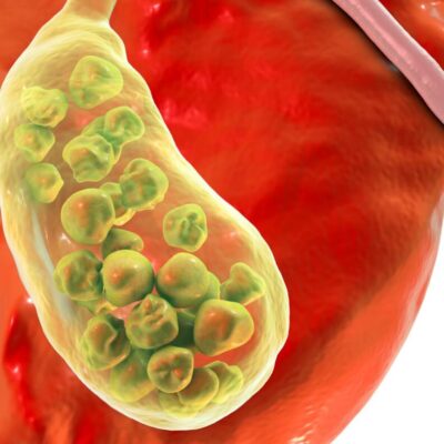 Quem souColecistite aguda: você sabe o que é?